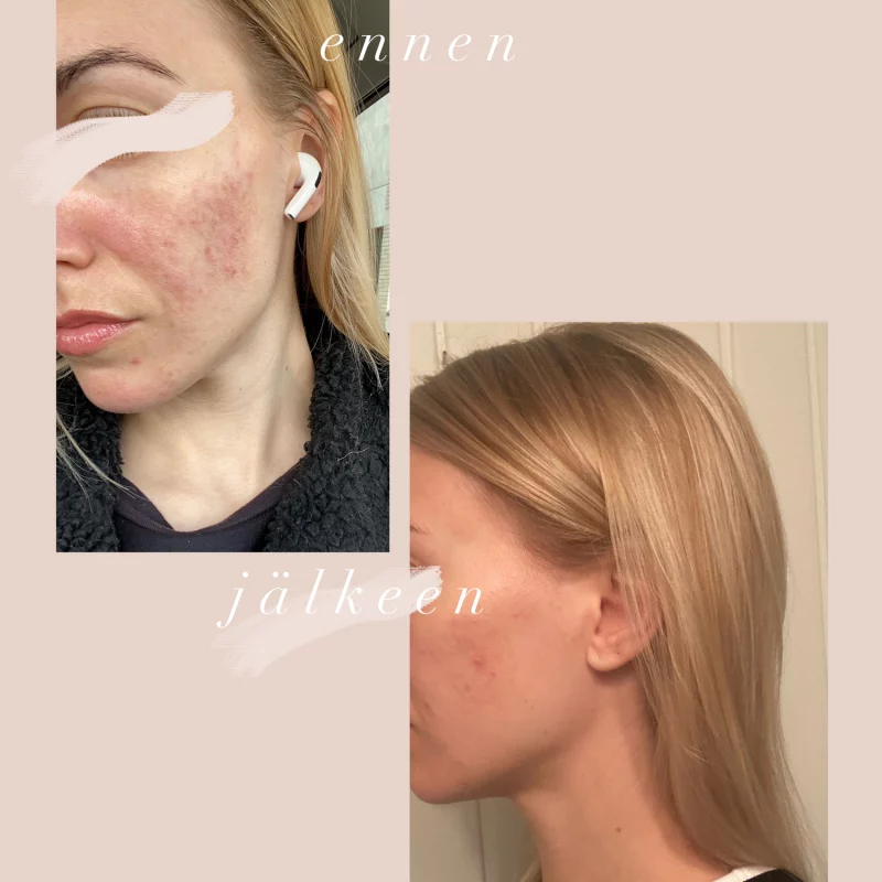 Tea Tree & Vide Ansiktsolja – 30 ml - Bild 3